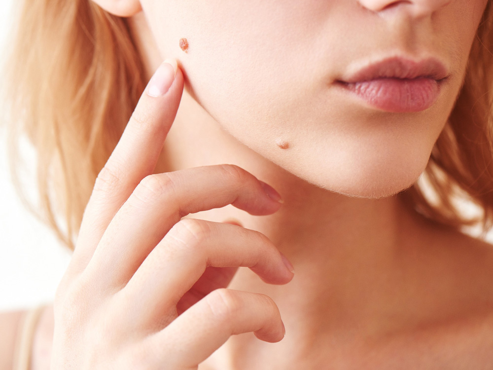 Cosmetic Mole Removal